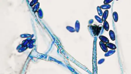 Mold Exposure Symptoms – Testing and Detection